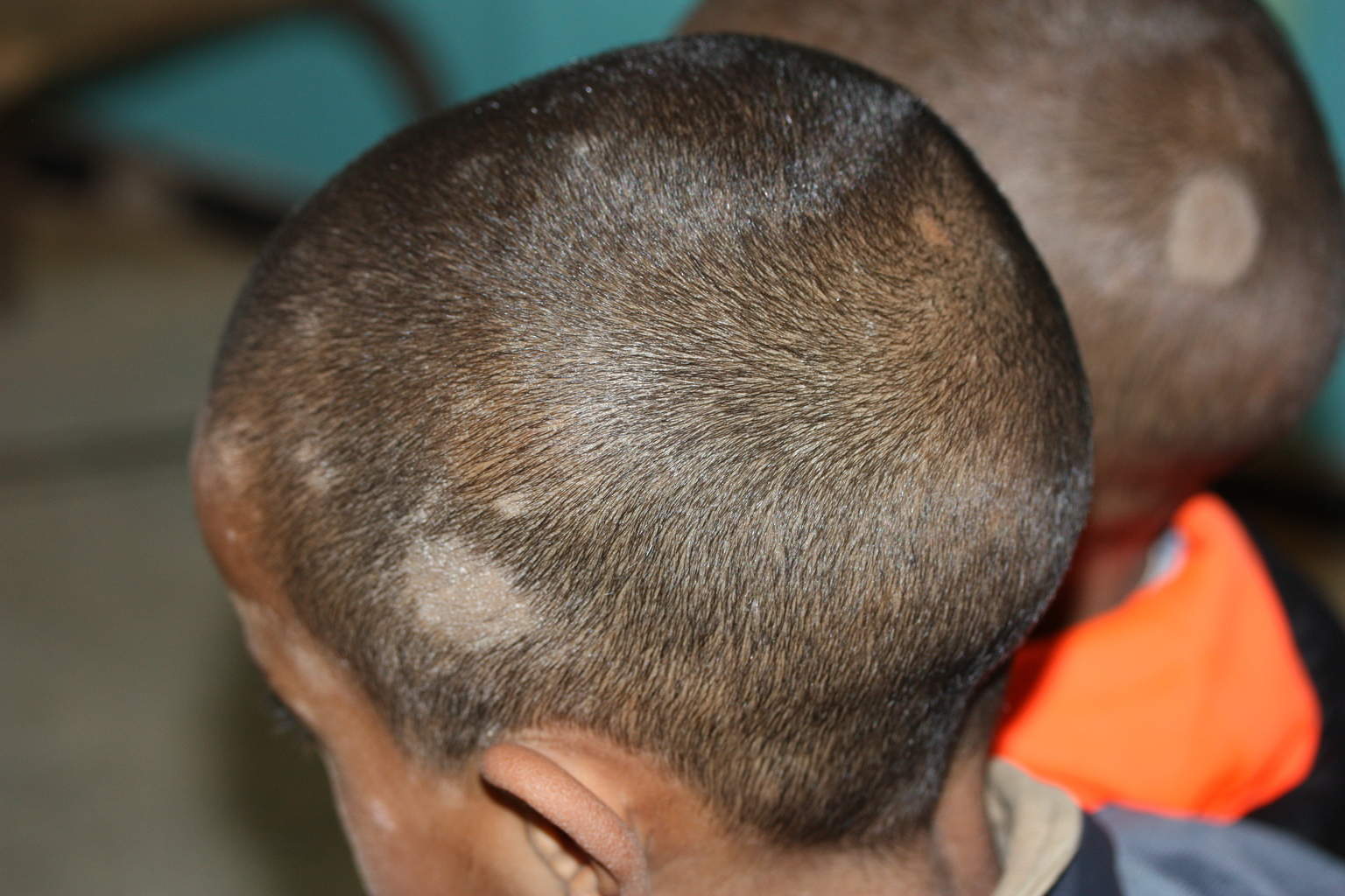 La teigne chez l’enfant : Traitement et précautions - Votre Santé