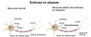 sclerose-en-plaques-mecanisme