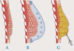 lipofilling-des-seins