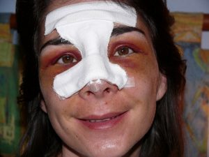 rhinoplastie3